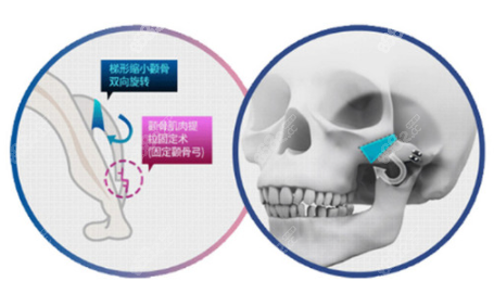 何晋龙和李志海磨骨区别是什么呢？