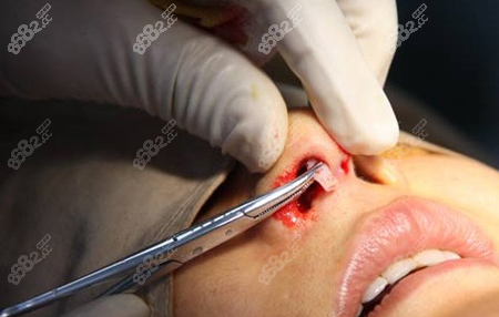 假体隆鼻手术过程图