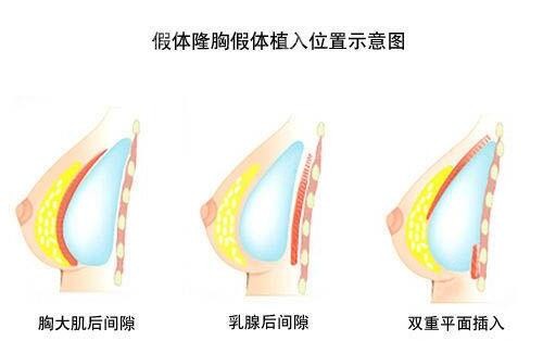 长沙做隆胸好的医生名单公布