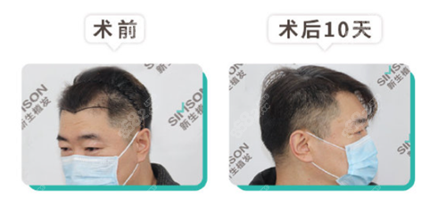 合肥<!--<i data=20240705-sp></i>-->植发效果