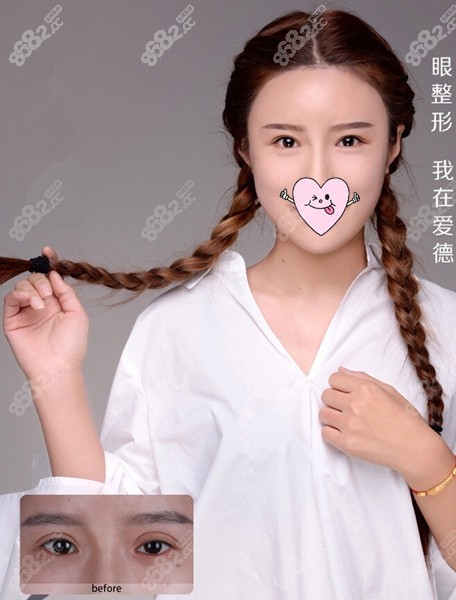 冯守运医生修复双眼皮图片