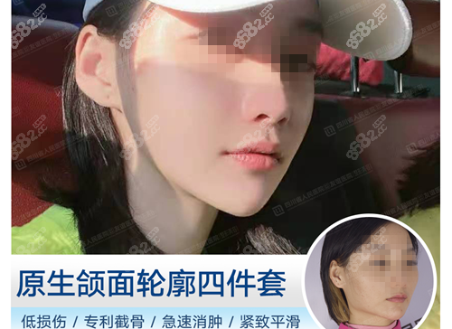 四川友谊张立天做下颌角磨骨前后对比图