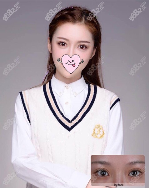 大连爱德丽格冯守运做眼修复对比图
