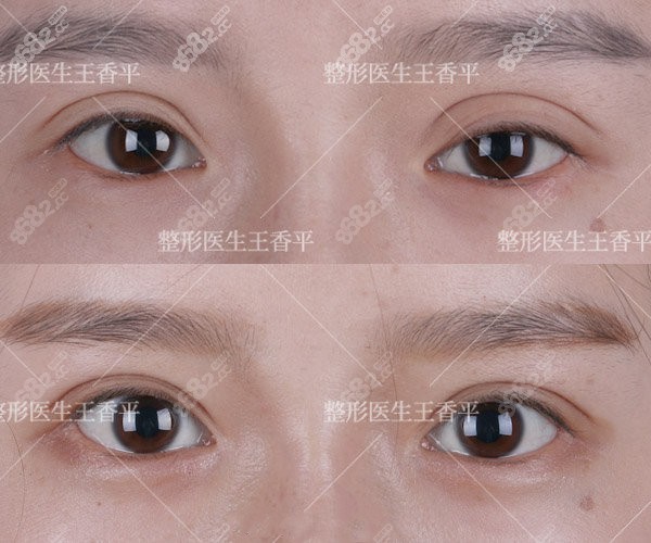 王香平医生修复宽双眼皮