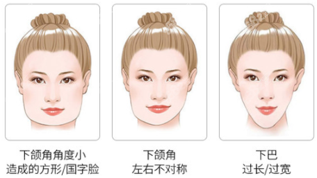 張柱允磨骨技術(shù)怎么樣呢？