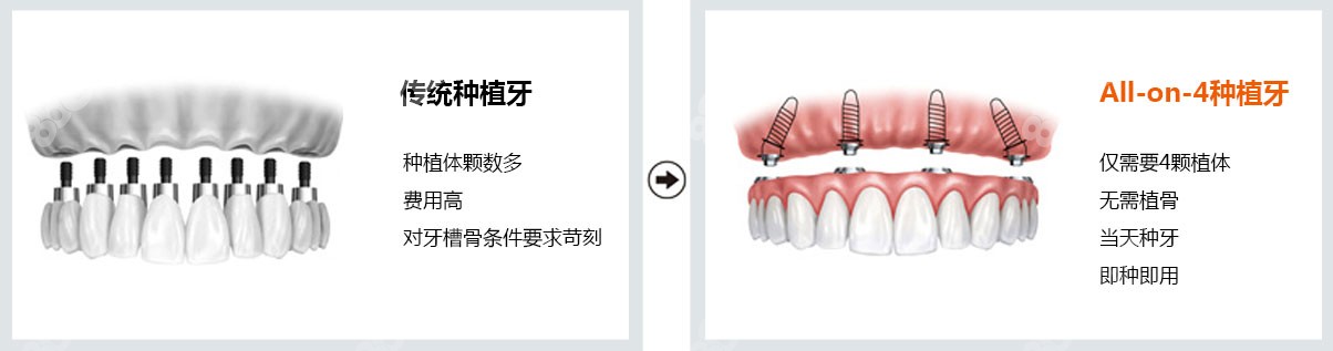 all-on-4种植牙和传统种植牙区别