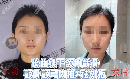 四川友谊张立天医生长曲线下颌角截骨+颧骨颧弓改善前后对比效果图