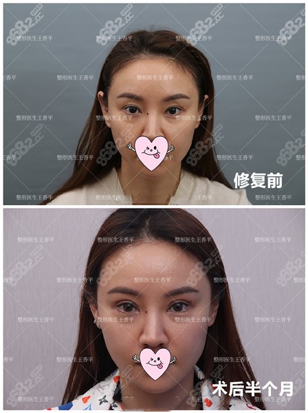 王香平医生做眼修复效果