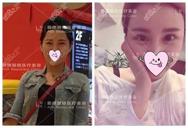 大连冯守运医生修复双眼皮效果图