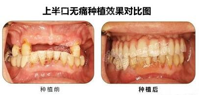 江继强医生成功病例：采用上半口半固定种植技术