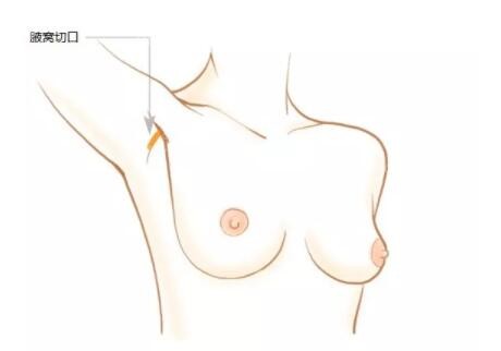 郑州美莱采用腋下切口植入隆胸假体优势