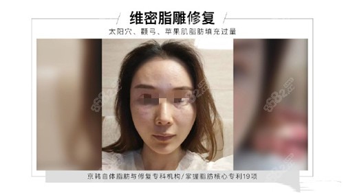 乔爱军脂肪修复后效果图