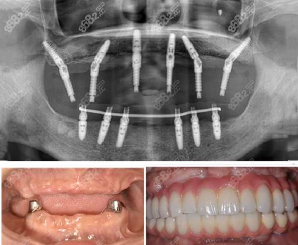 镶全口牙图片图片