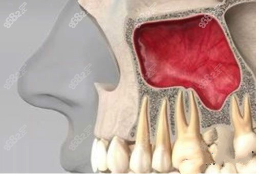 易继恩上颌窦内提升术种植牙