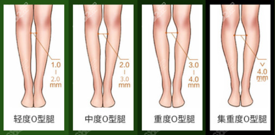 李奇军做大腿吸脂能矫正0型腿、X型腿