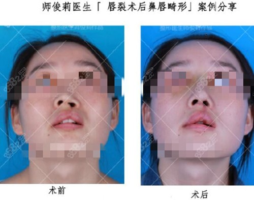 西安国医整形中心医院师俊莉唇裂鼻修复术前术后对比