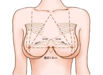 北京叶子医院隆胸依据的美学标准