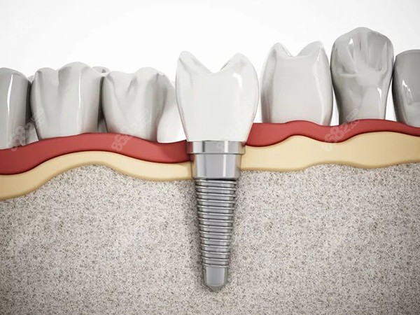 种植牙的成败主要在于牙槽骨的质量