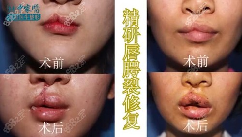 广州中家医家庭医生黄广香唇腭裂术前术后对比