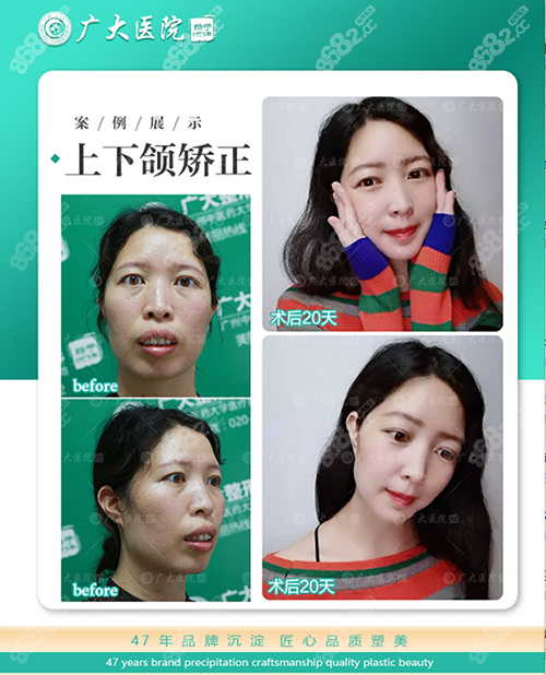何锦泉正颌手术真人效果图一