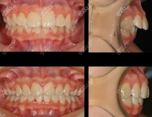 上海鼎植口腔医院牙齿矫正术前术后对比