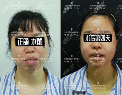广州广大何锦泉正颌手术前后对比照