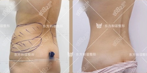<!--<i data=20240705-sp></i>-->冯斌腰腹环吸效果图