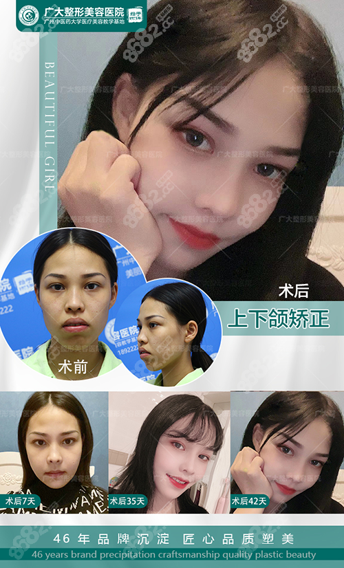 何锦泉正颌手术真人效果图一 何锦泉正颌手术真人效果图二