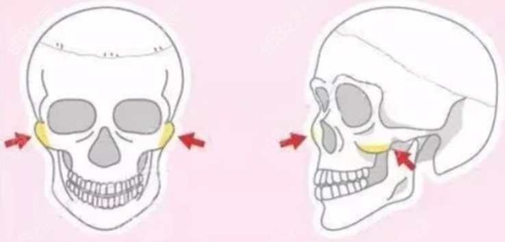 颧骨内推整形手术