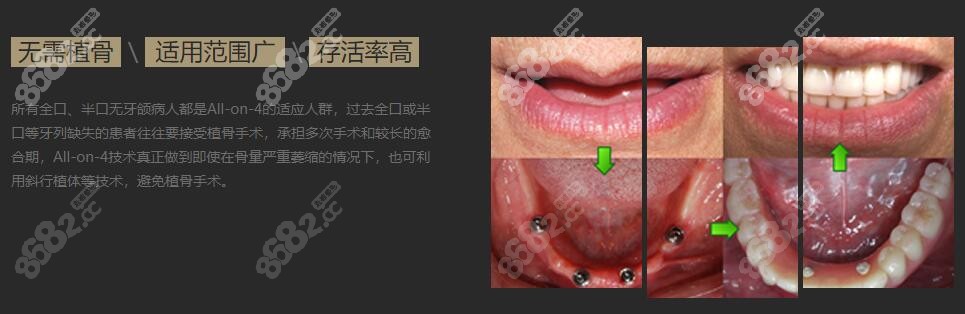ALL-ON-4种植技术，无需植骨
