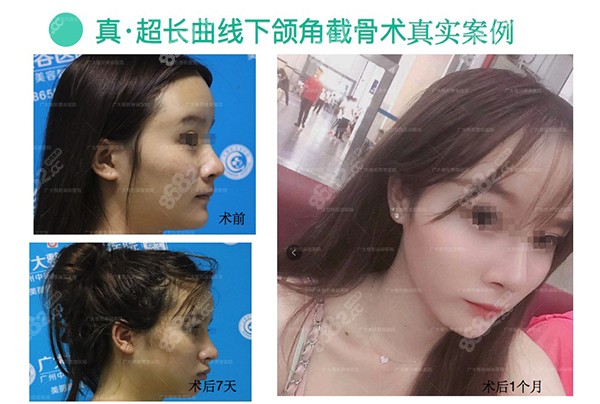 真·超长曲线下颌角截骨术真人分享