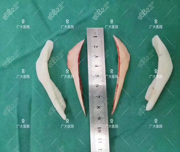 下颌角截骨后