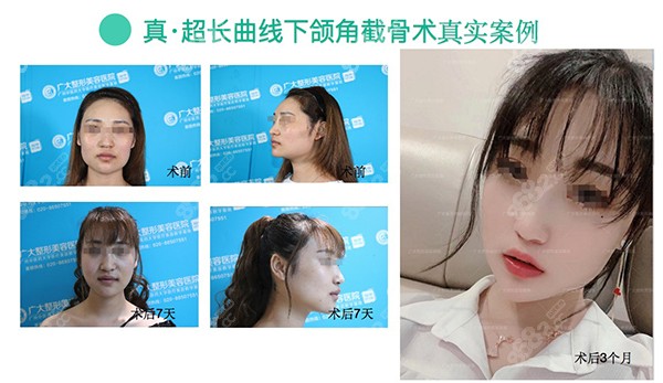 真·超长曲线下颌角截骨术<span style=