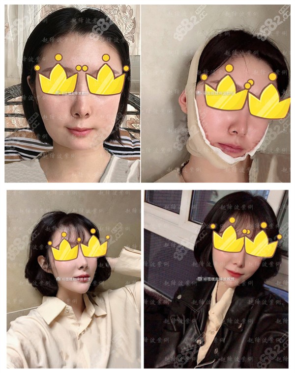 赵绛波医生长曲线下颌角整形前后对比照