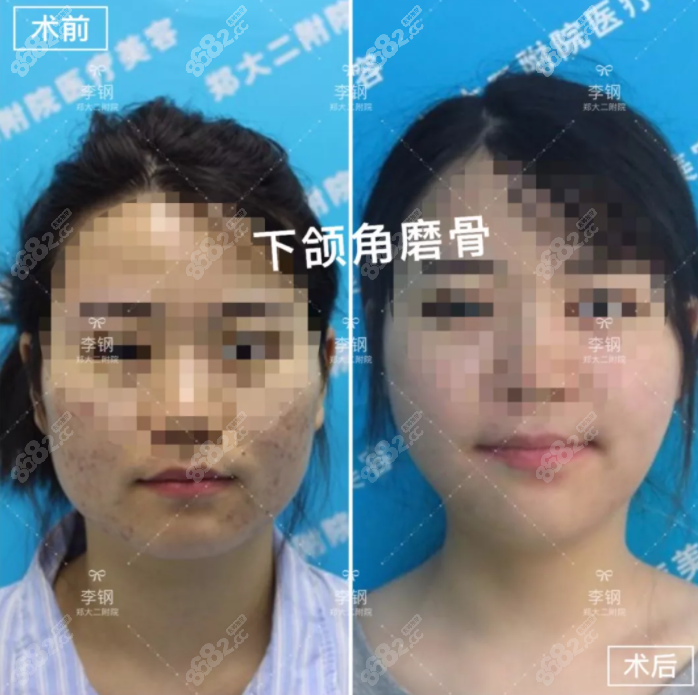 李钢医生下颌角磨骨对比照