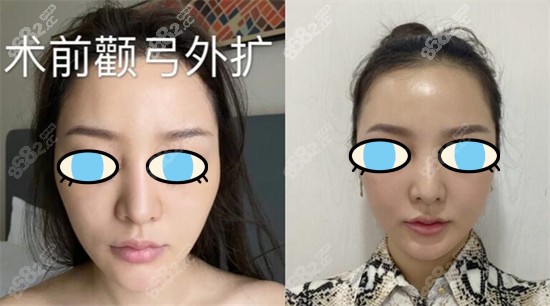 医院颧骨内推真人效果对比图片