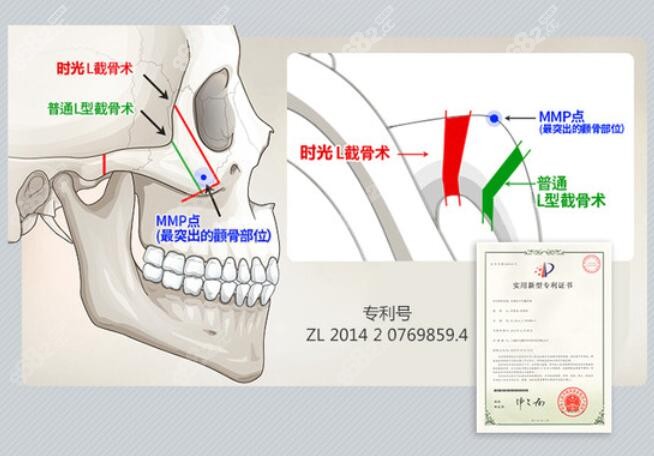 上海时光医院颧骨内推技术优势