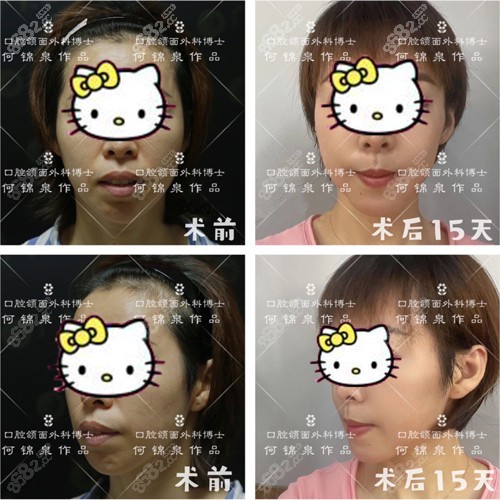 广大改善双颌前突术前术后对比