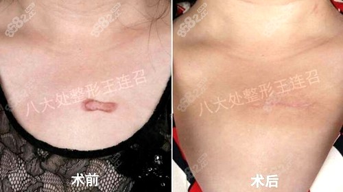 手术修复形5000元/单位剖腹产后腹部瘢痕修复10000元/单位疤痕软化