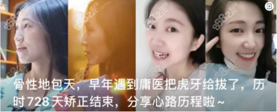 上海一例通过牙齿矫正解决地包天的手术