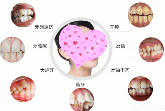 宁波牙博士口腔医院牙齿矫正适应症