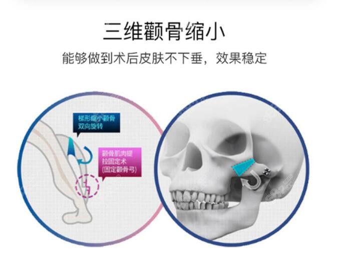 上海华美医院颧骨内推做得好的亮点