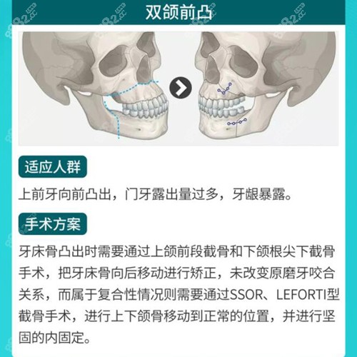 改善双颌前突广州广大用双鄂手术