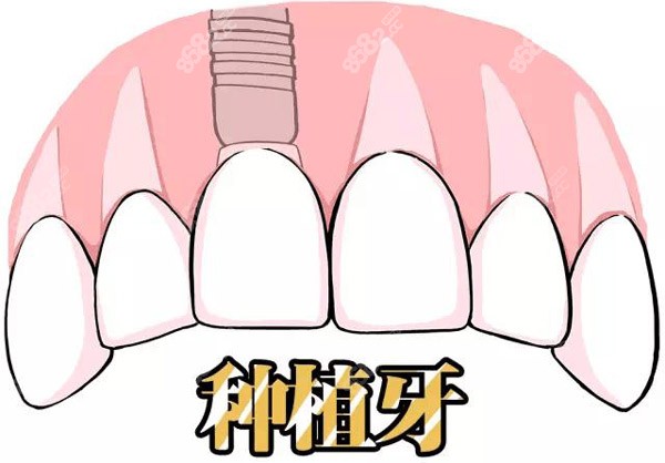 广州哪家医院种植牙技术比较好？