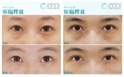 北京领医医疗美容去眼袋术前术后对比图