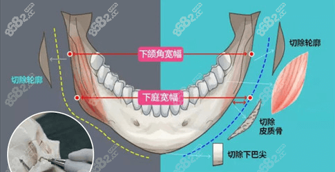 陈氏超声骨刀下颌角缩小示意图
