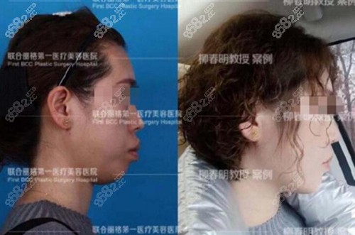 北京联合丽格柳春明正颌手术前后对比照