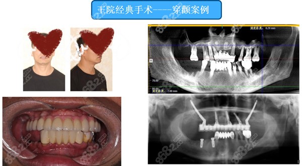 杭州美奥口腔王明院长穿颧病例