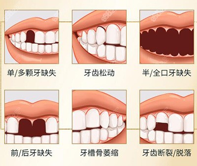 哪些牙齿需要做种植牙改善