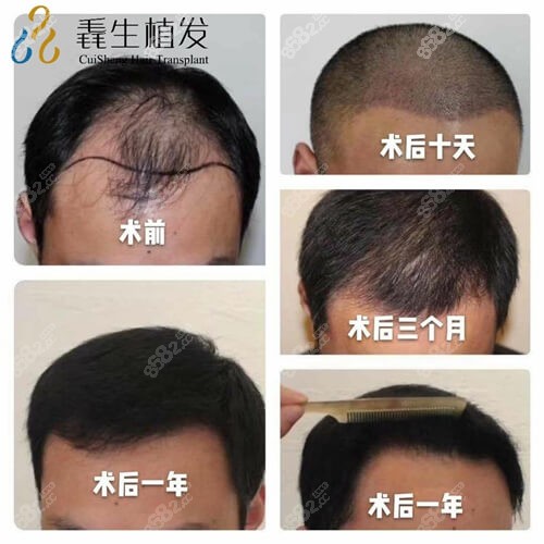 <!--<i data=20240705-sp></i>-->毳生植发发际线+头顶加密种植